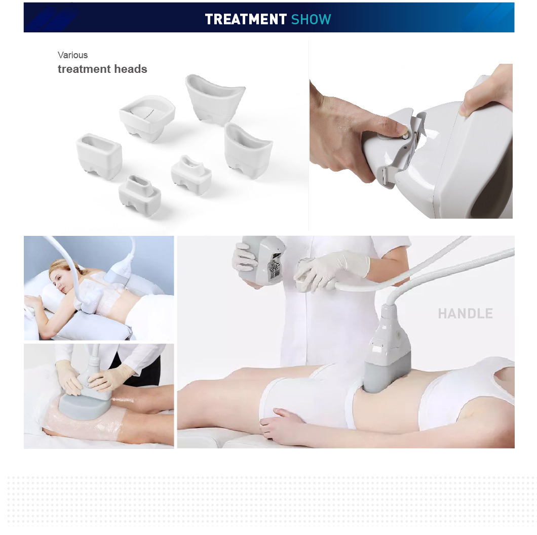 cryolipolysis prices